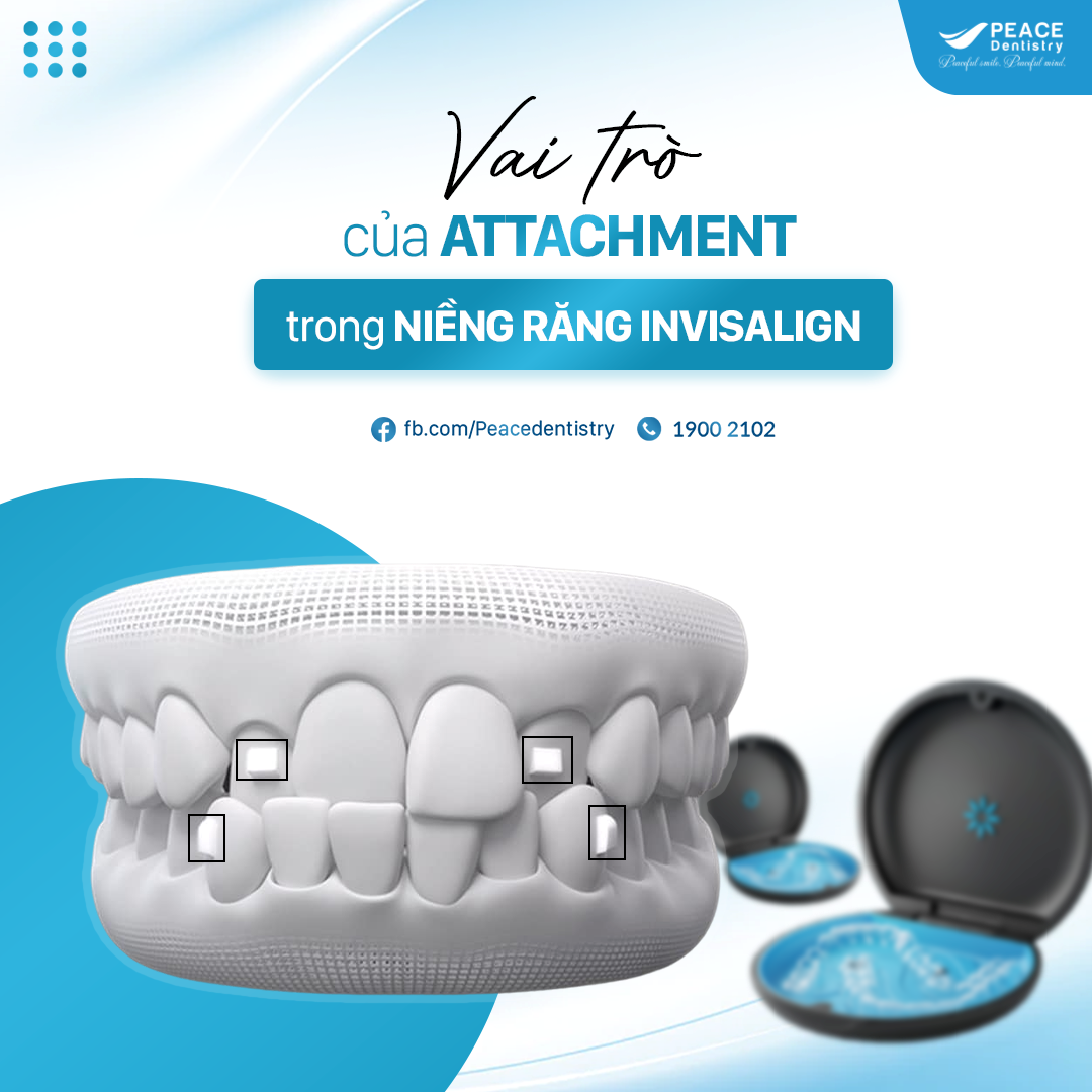 attachment trong niềng răng invisalign