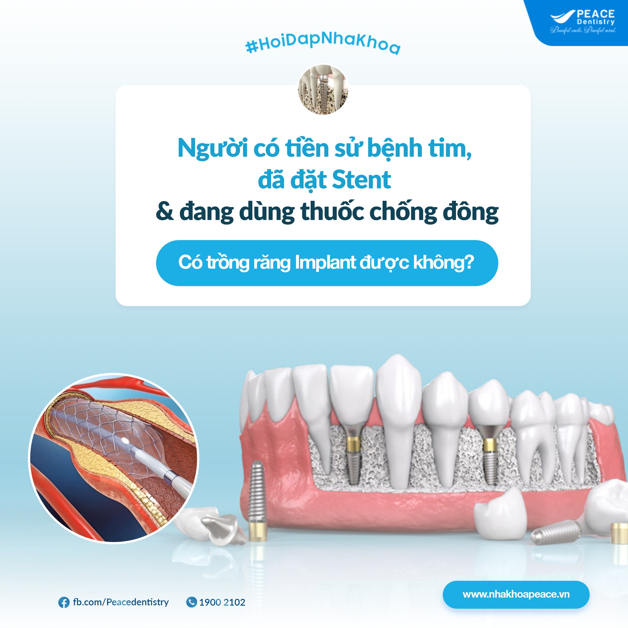 bệnh tim mạch có trồng răng implant được không