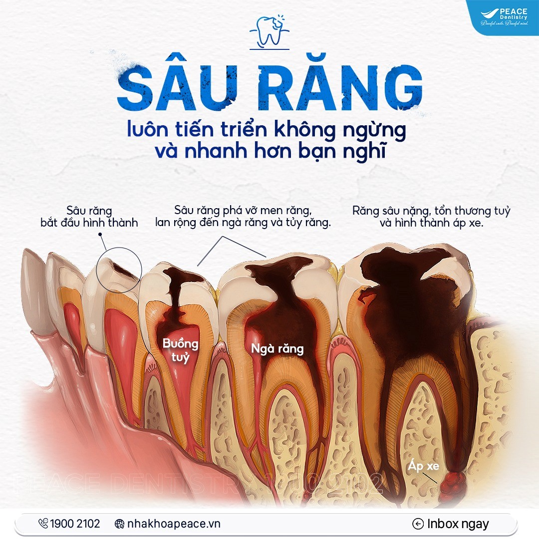 cách nhận biết răng sâu vào tuỷ