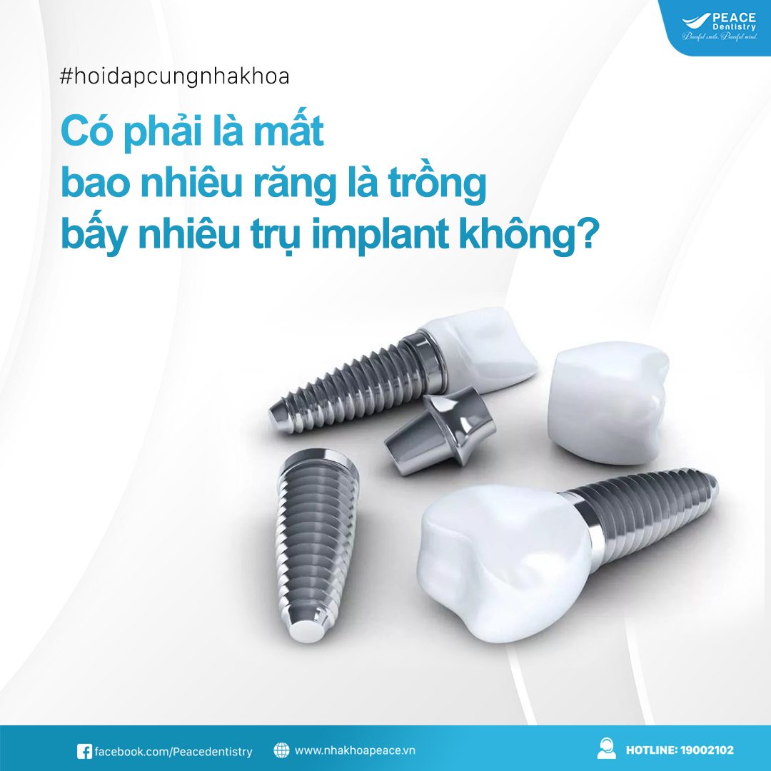 mất bao nhiêu răng thì trồng bấy nhiêu trụ implant