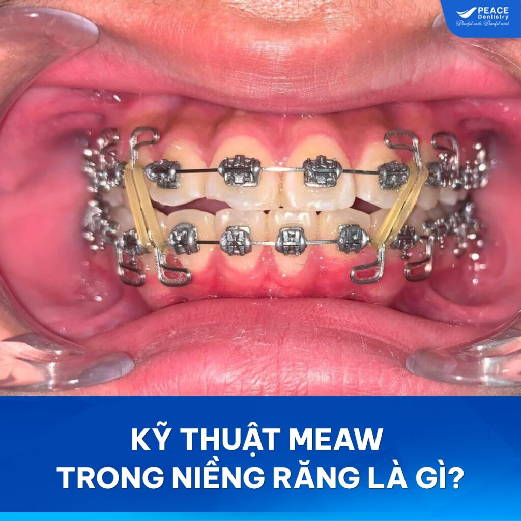 niềng răng bằng kỹ thuật meaw
