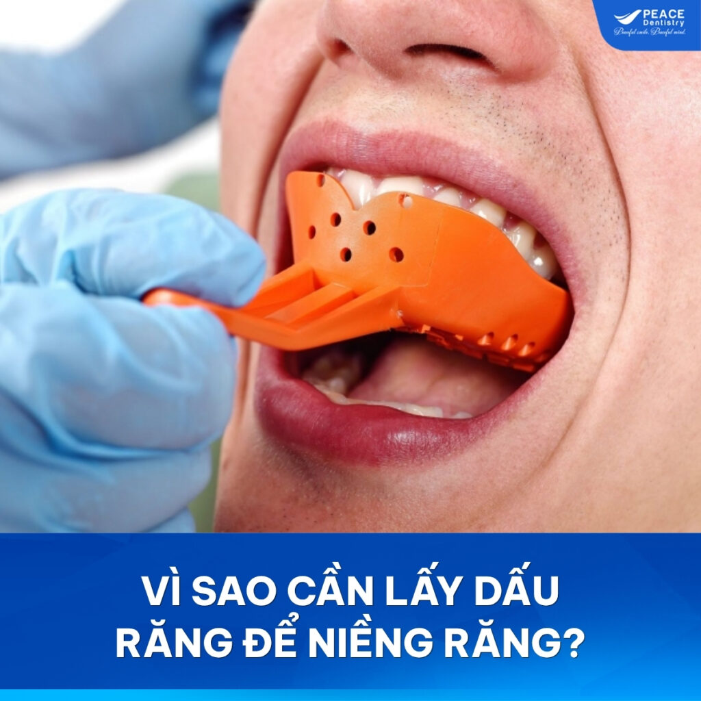tại sao cần lấy dấu hàm khi niềng răng