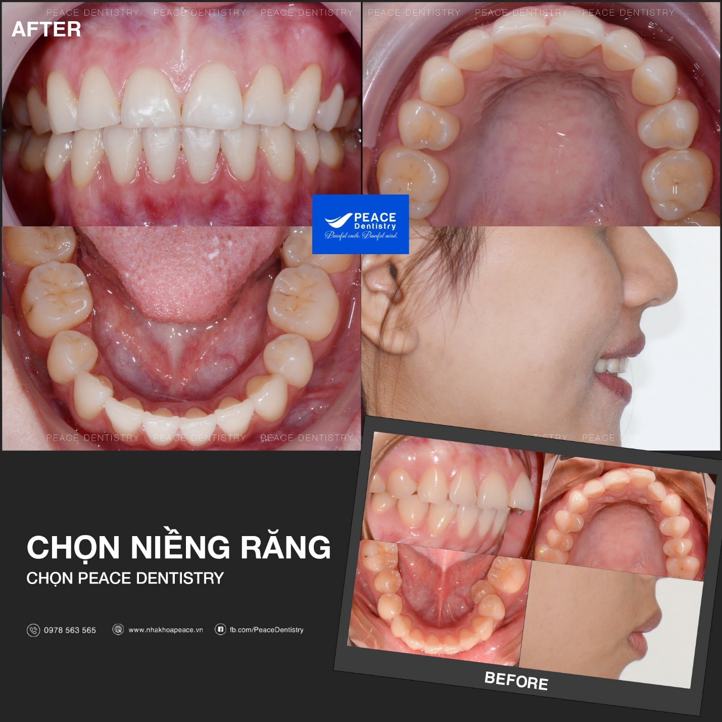 niềng răng hô nhẹ