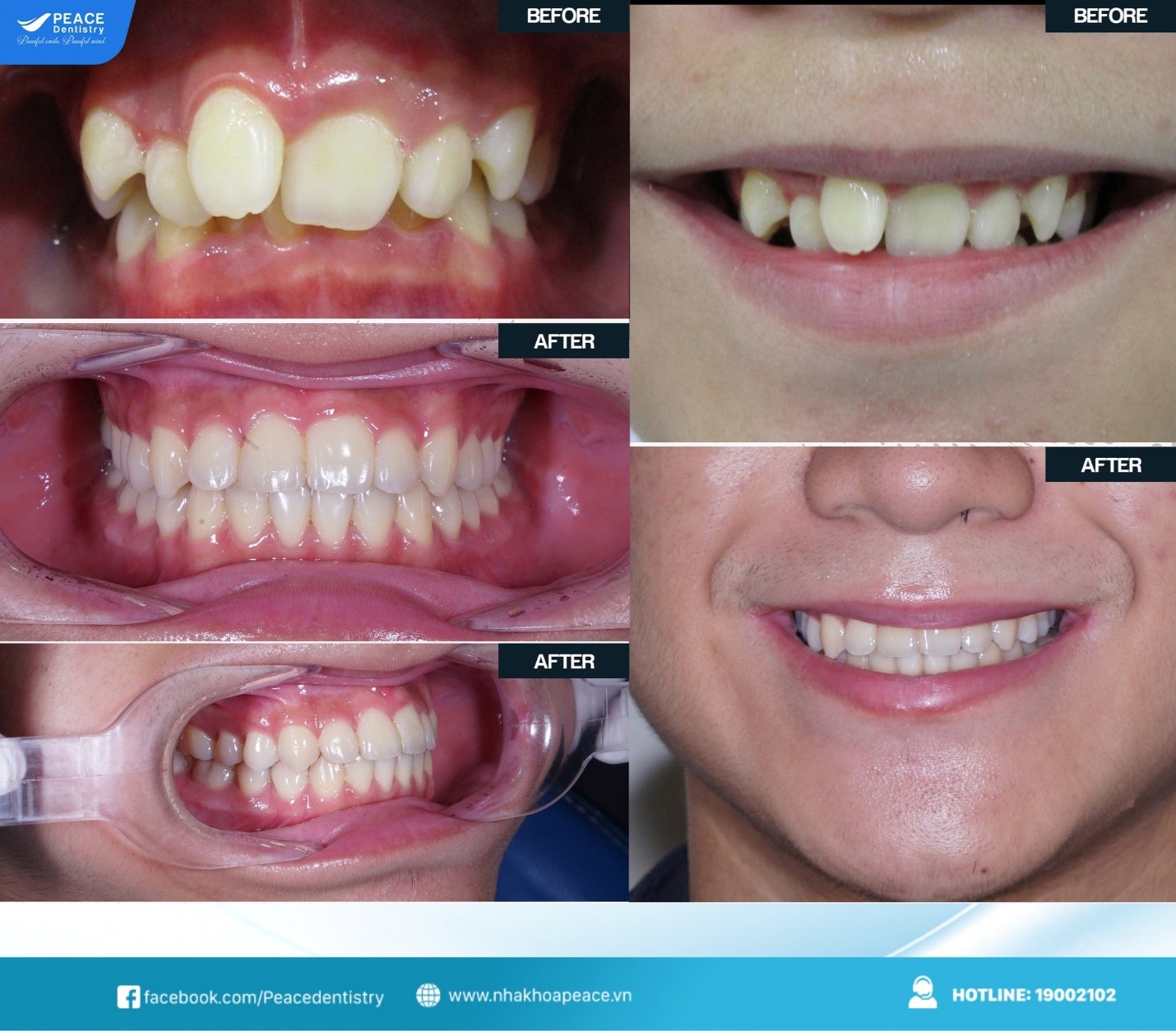 niềng răng invisalign cho răng hô