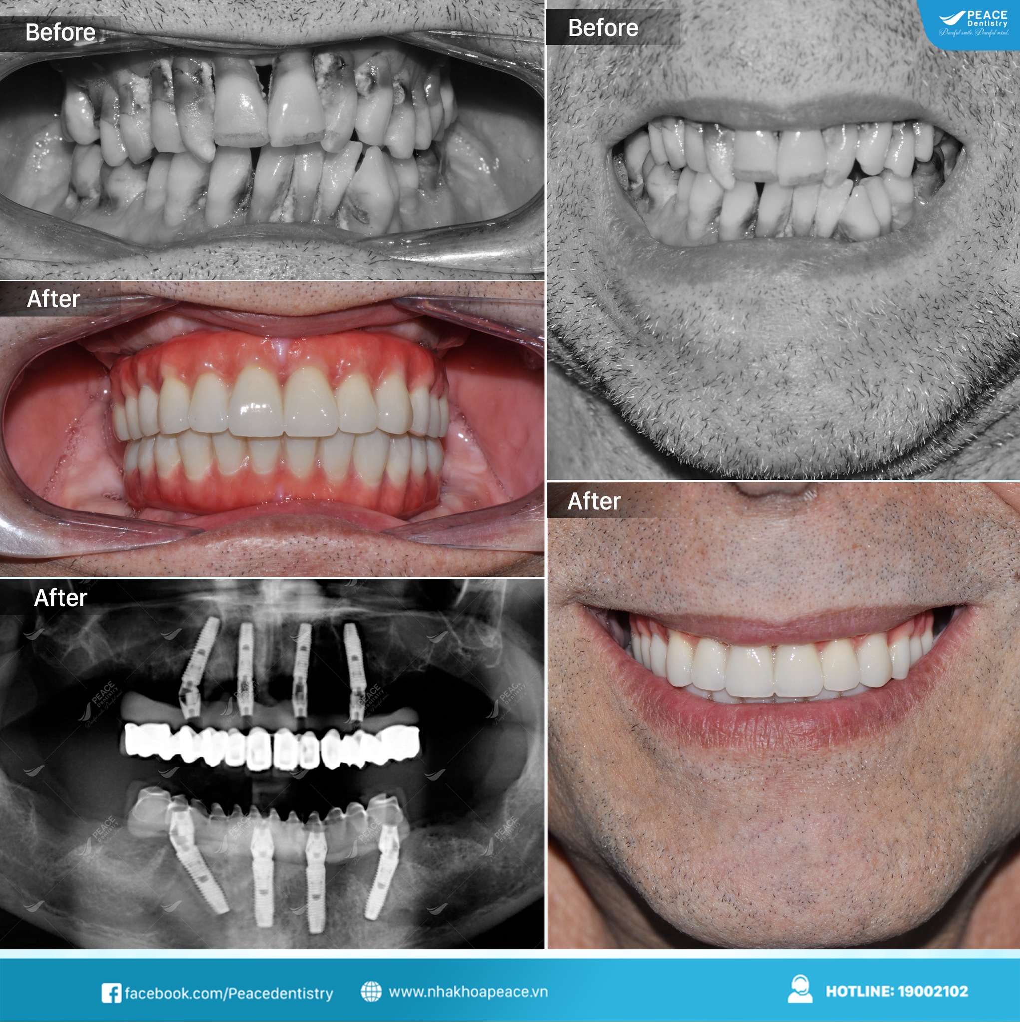 trồng răng implant all on 4 sau 12 ngày