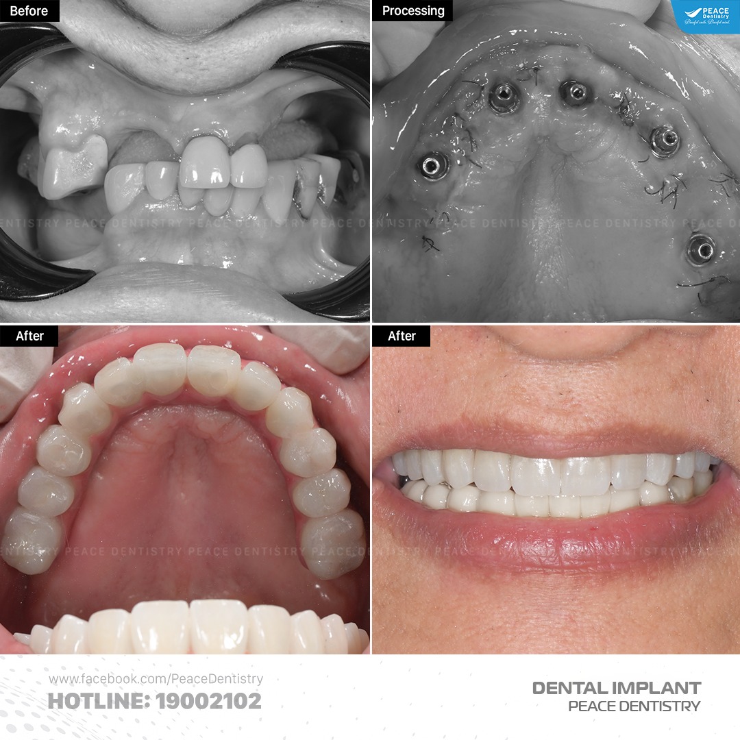 trồng răng implant all on 5 sau khi nhổ răng