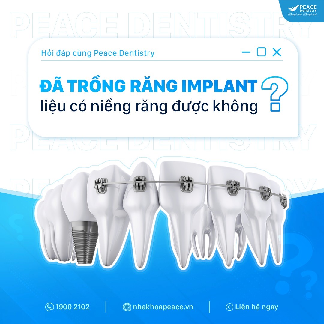 trồng răng implant có niềng răng được không