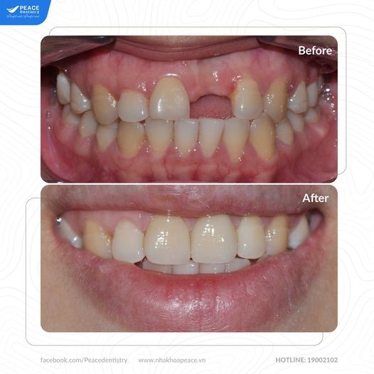 trồng răng implant khắc phục tiêu xương hàm