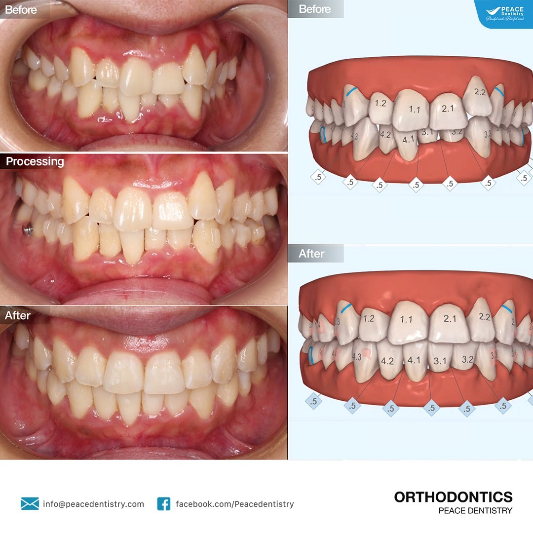 vai trò attachment trong niềng răng invisalign