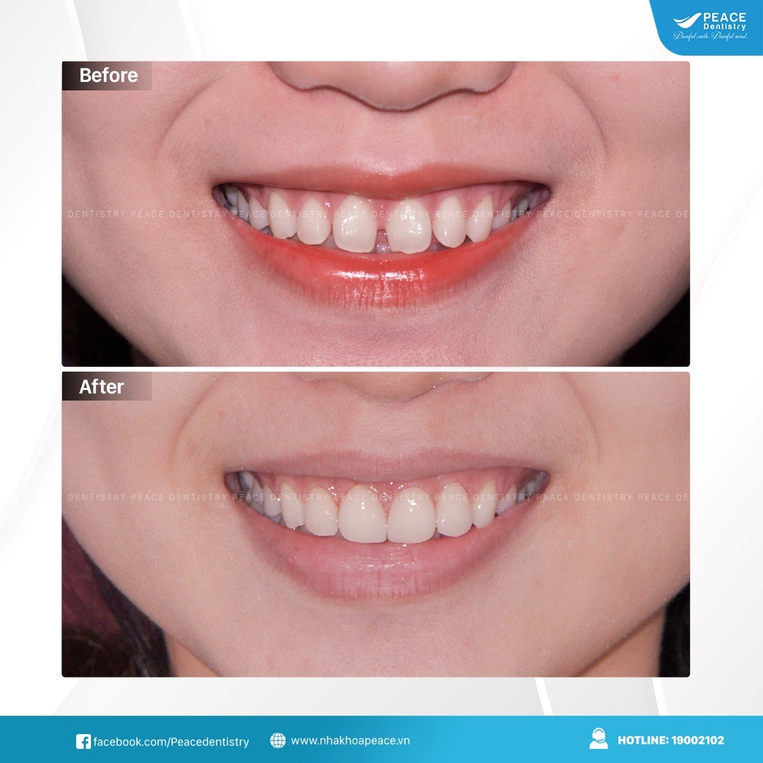 dán sứ veneer tại nha khoa peace dentistry