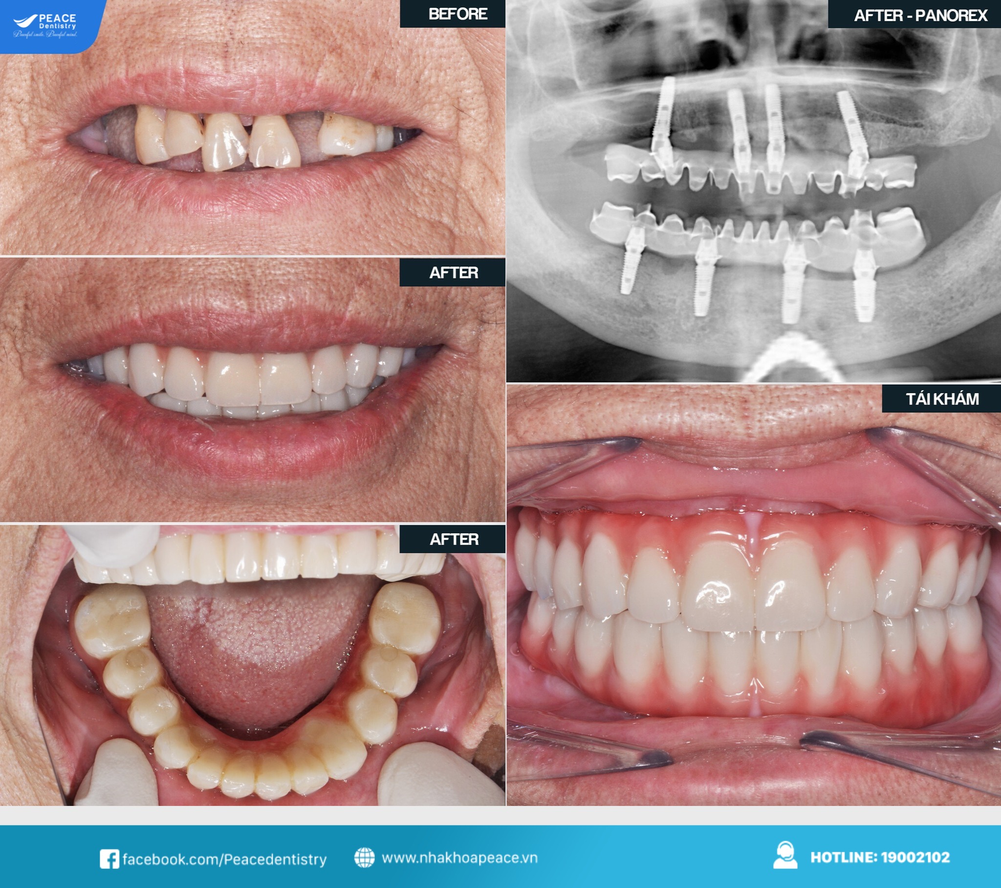 nha khoa trồng răng implant đà nẵng