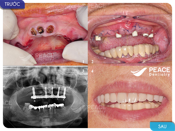 nhổ chân răng cũ và trồng implant all on 5 toàn hàm trên