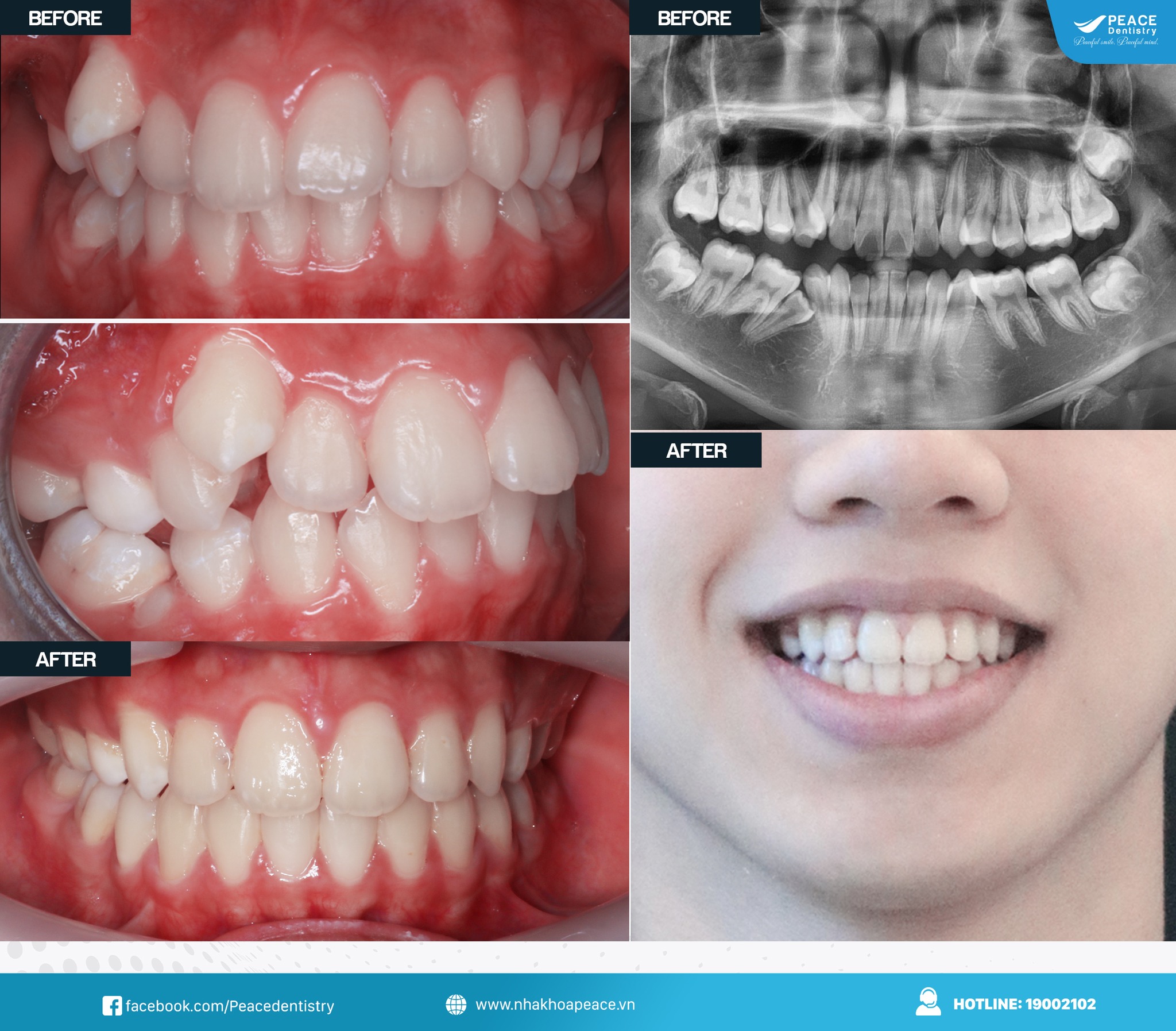 ca lâm sàng niềng răng khấp khểnh tại peace dentistry