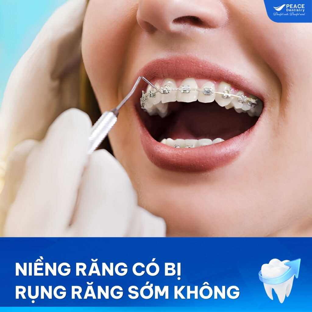 niềng răng có bị rụng răng không