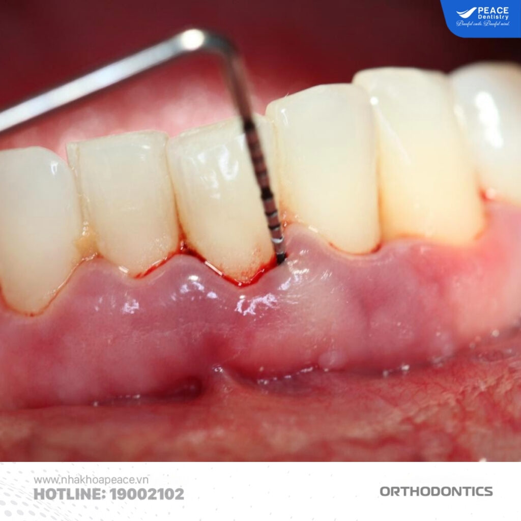 Chưa điều trị dứt điểm viêm nha chu trước khi niềng có thể khiến răng bị lung lay