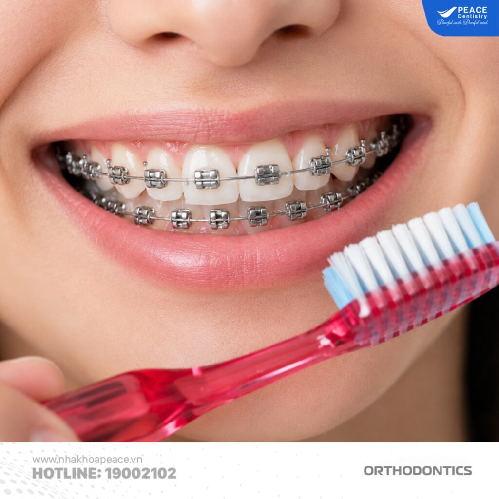 Chăm sóc răng miệng đúng cách để niềng răng hiệu quả