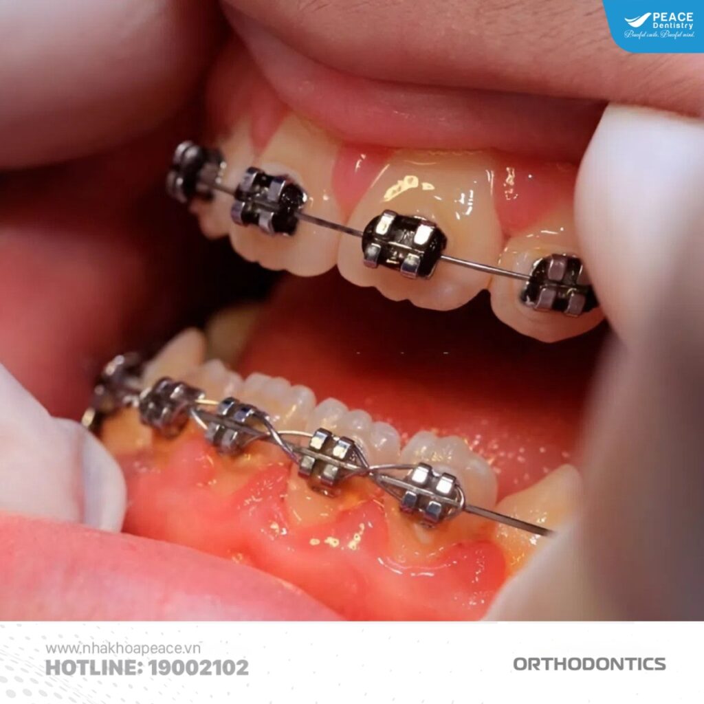 viêm nha chu là nguyên nhân phổ biến gây tam giác nướu