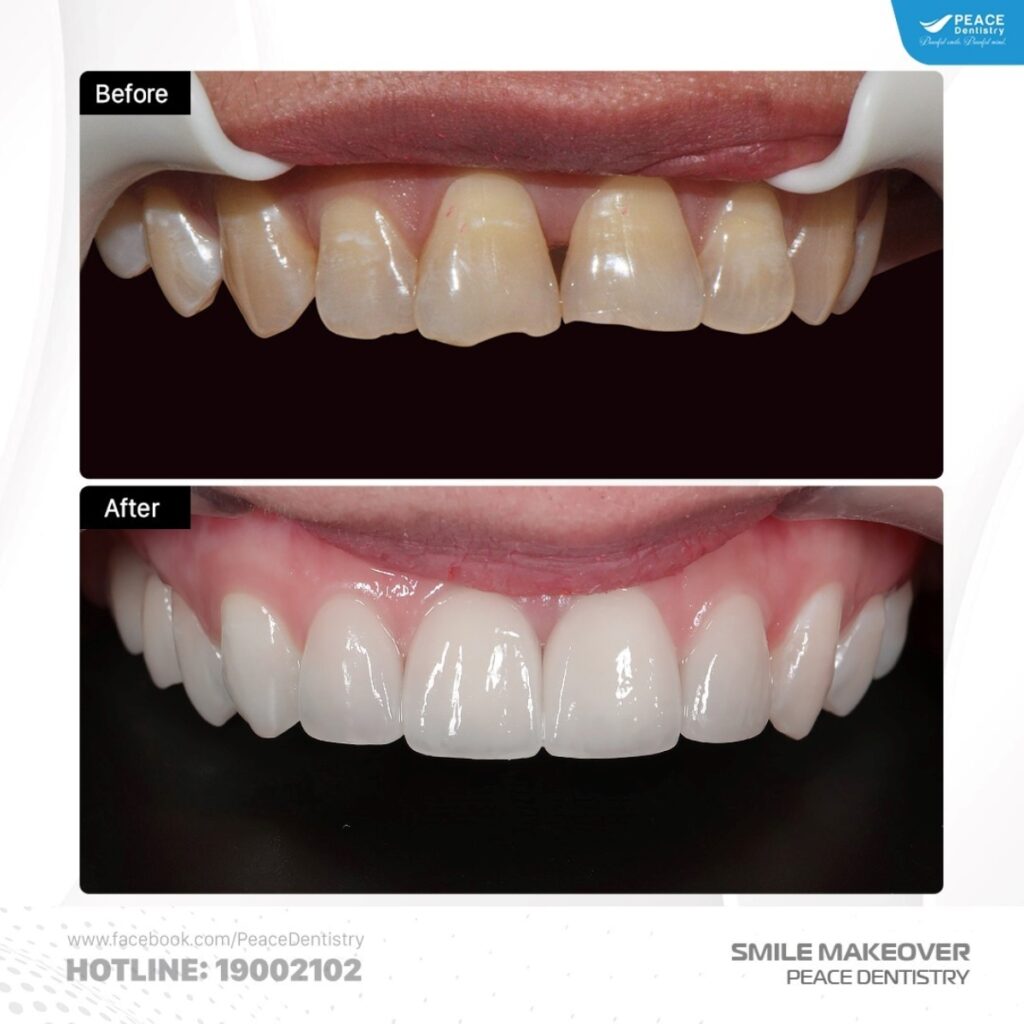 hình ảnh trước và sau khi dán sứ Veneer tại Peace Dentistry