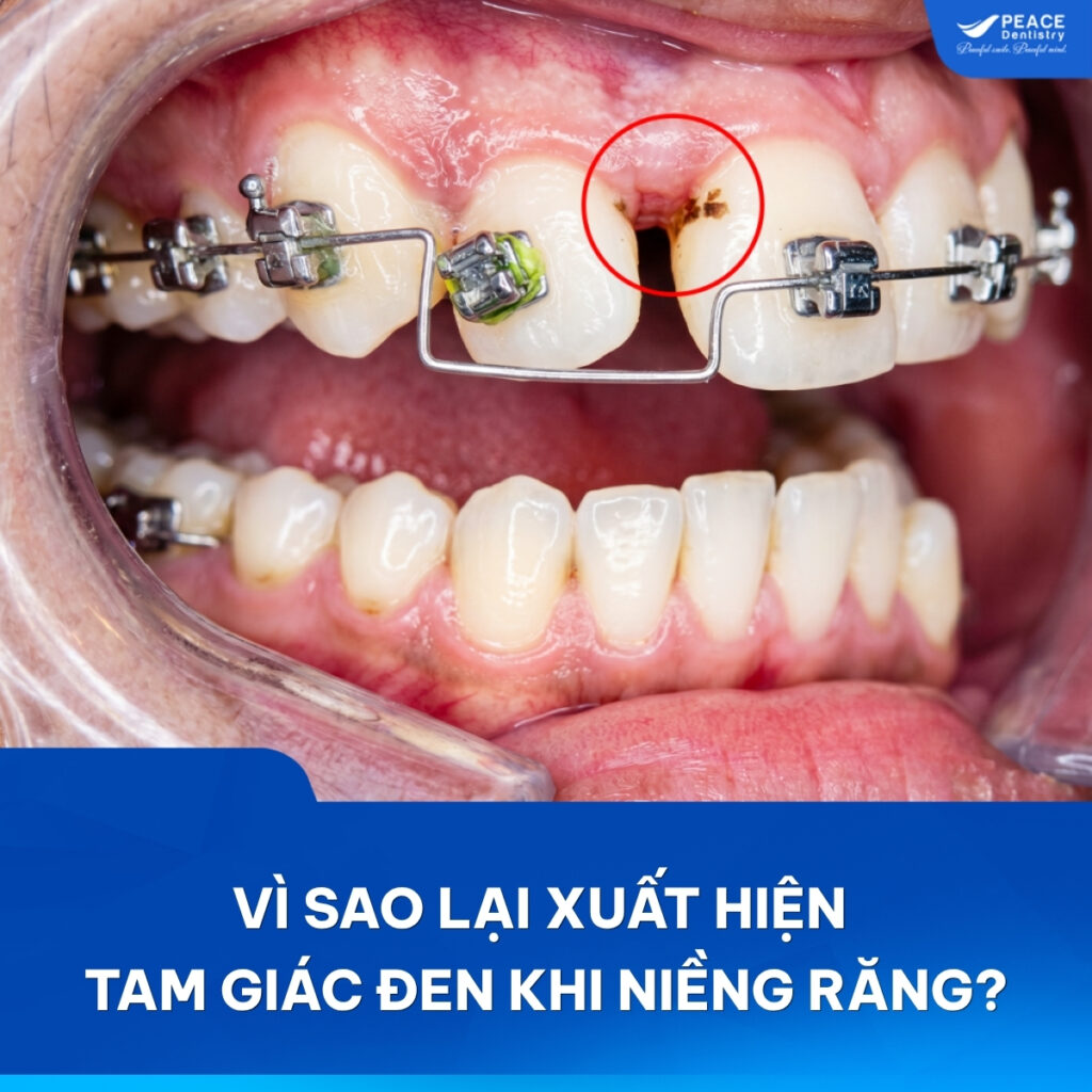 tam giác kẽ răng khi niềng