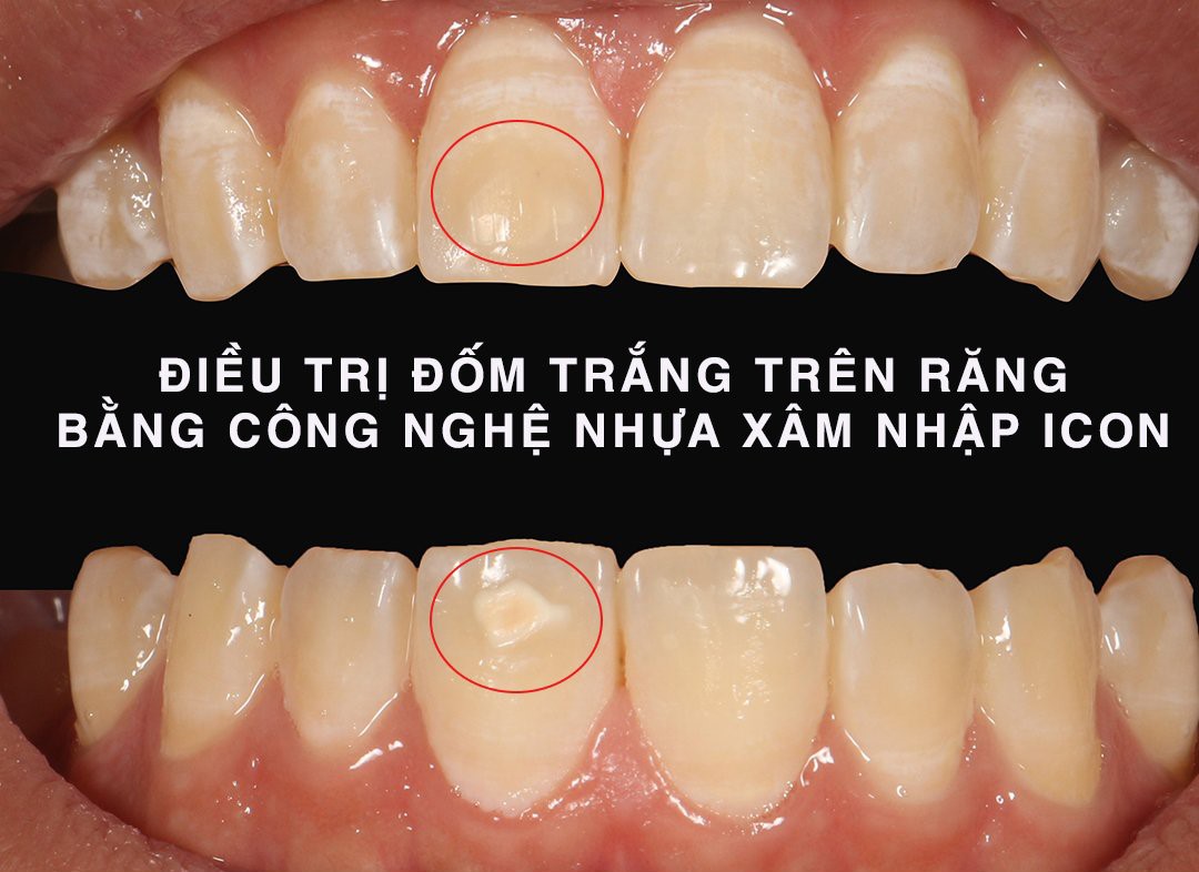 cách trị đốm trắng trên răng bằng icon