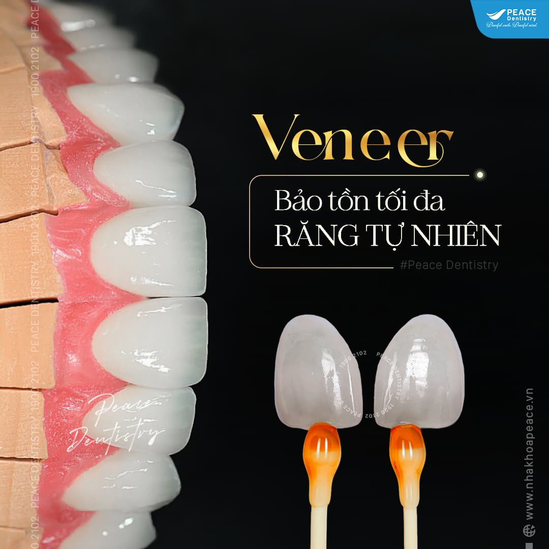 dán sứ veneer xử lý men răng tối thiểu