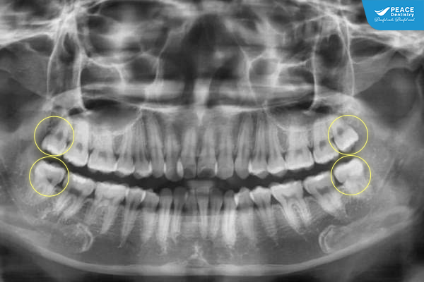 lợi ích răng khôn mọc thẳng