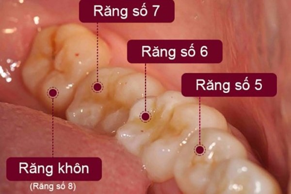 mọc răng khôn hàm dưới