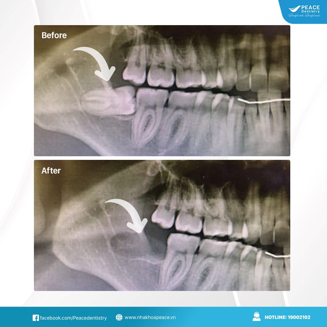 nhổ răng khôn hàm dưới tại peace dentistry