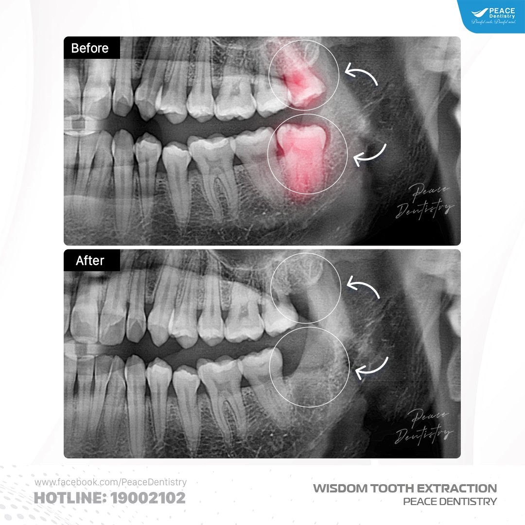 nhổ răng khôn mọc thẳng có đau không