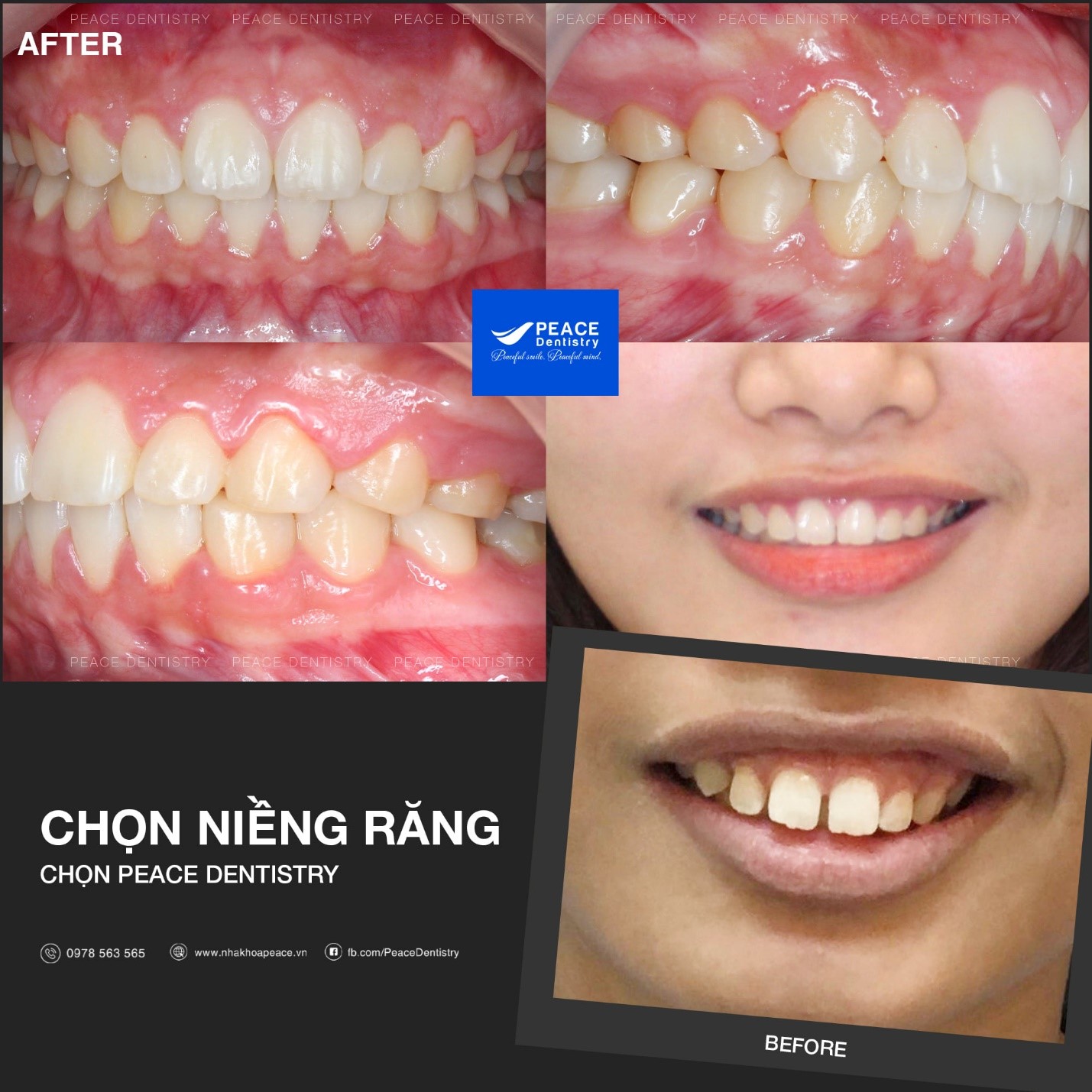 niềng răng hô có cần nhổ răng không