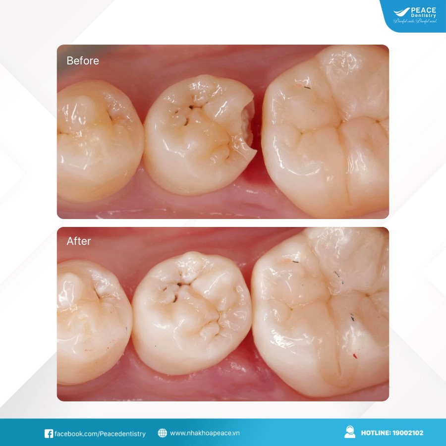 trám răng cho răng hàm bị sâu kẽ