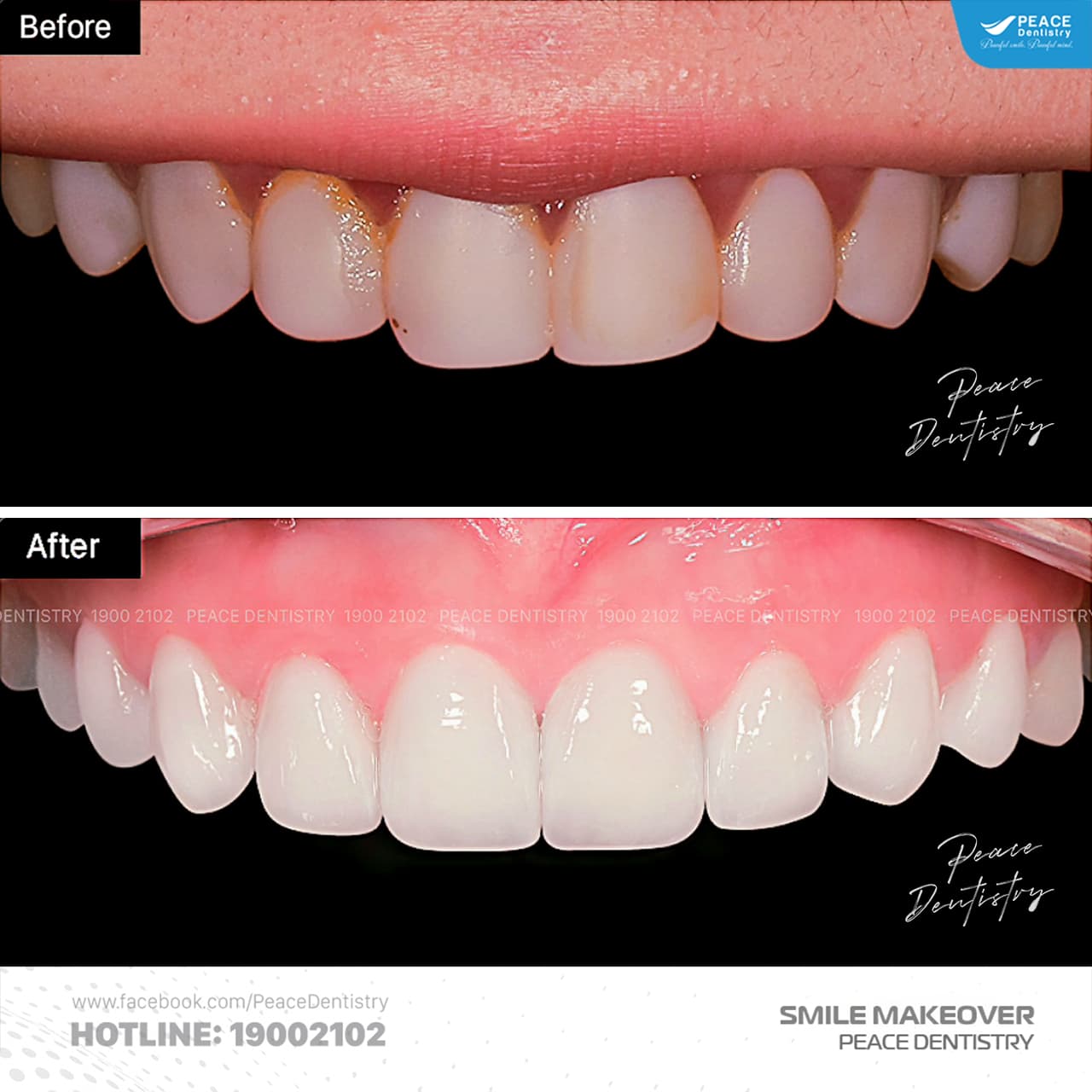 veneer sứ trắng sang trọng