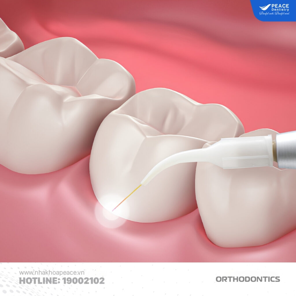cắt nướu bằng laser
