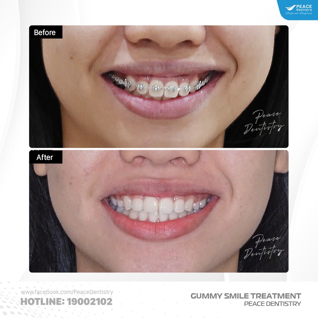 điều trị cười hở lợi tại peace dentistry