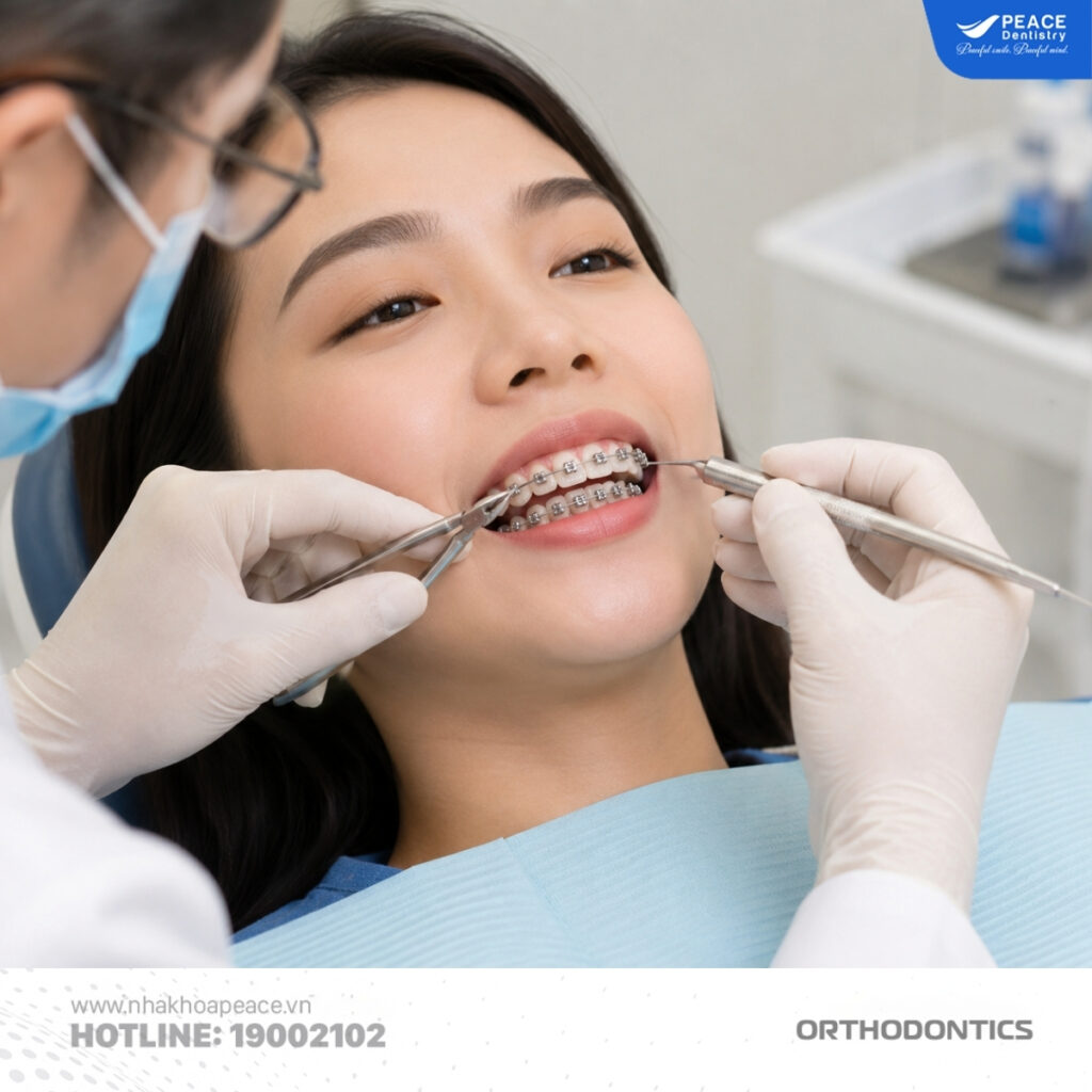 Không tự ý tháo niềng, hãy tuân theo chỉ định của bác sĩ