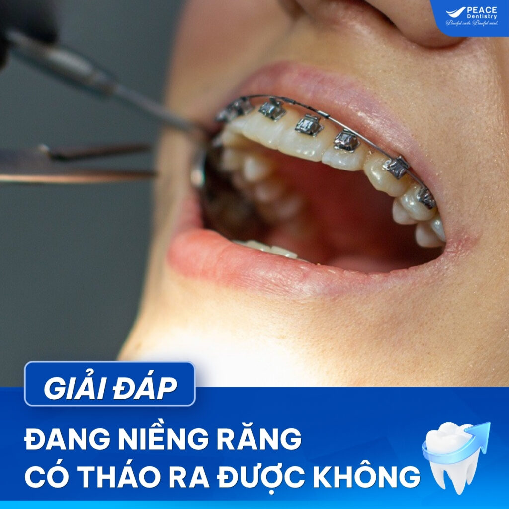 đang niềng răng tháo ra được không