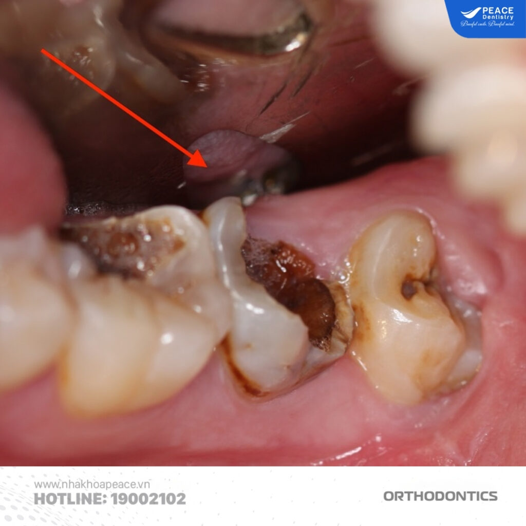 trường hợp cần tháo niềng răng sớm