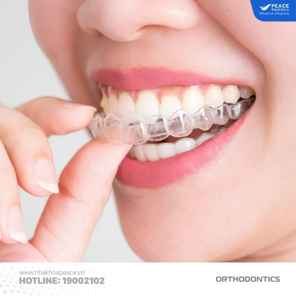 niềng răng trong suốt invisalign tại peace dentistry