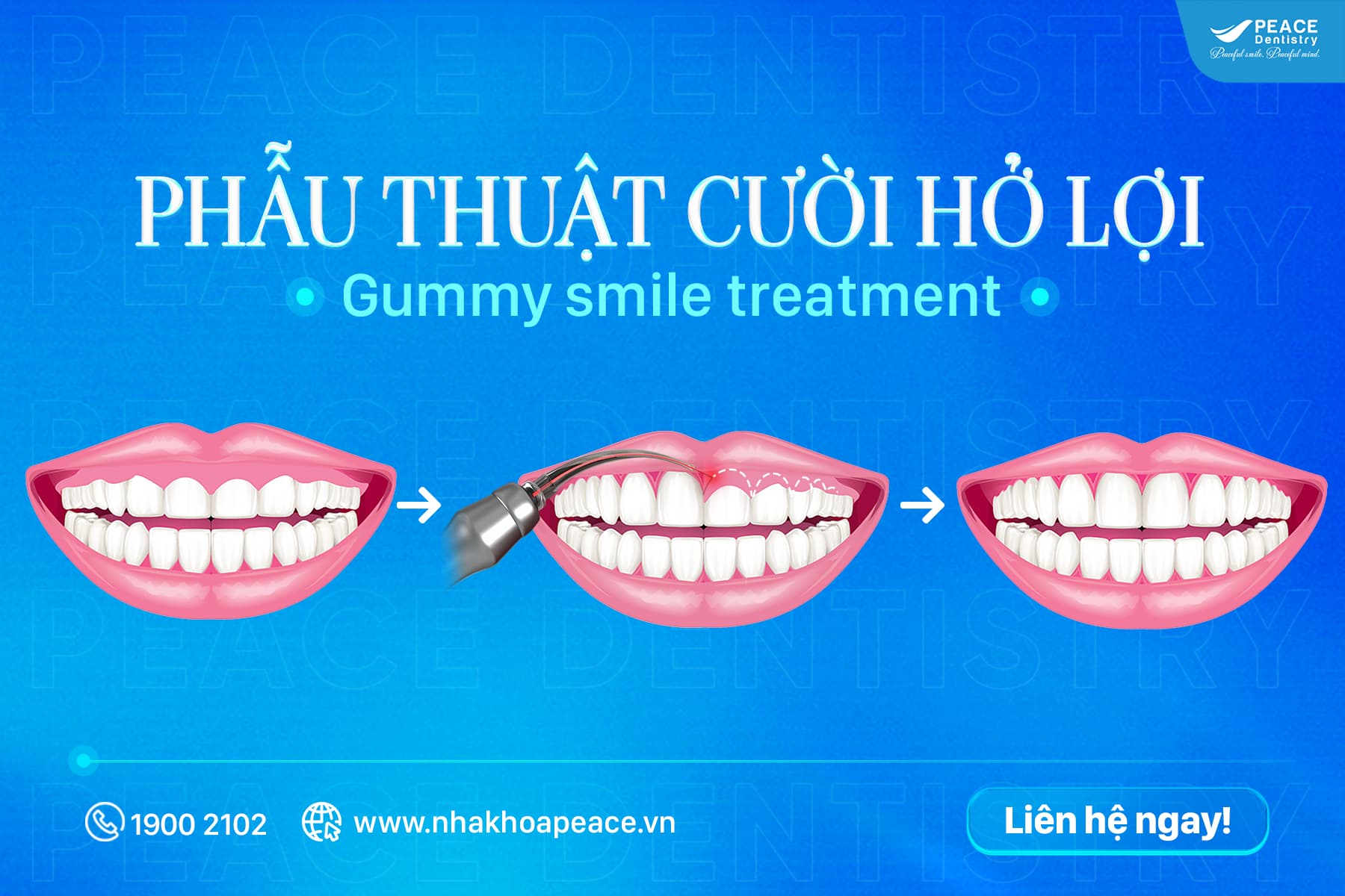 điều trị cắt nướu tại peace dentistry