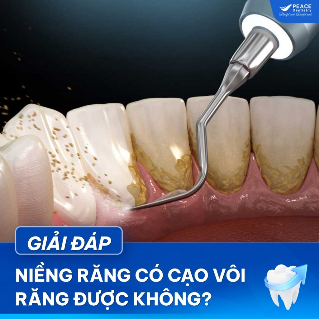 niềng răng có lấy cao răng được không