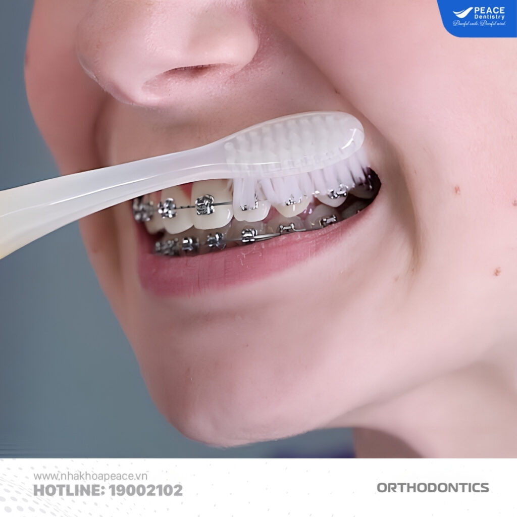 cách hạn chế vôi răng khi niềng răng