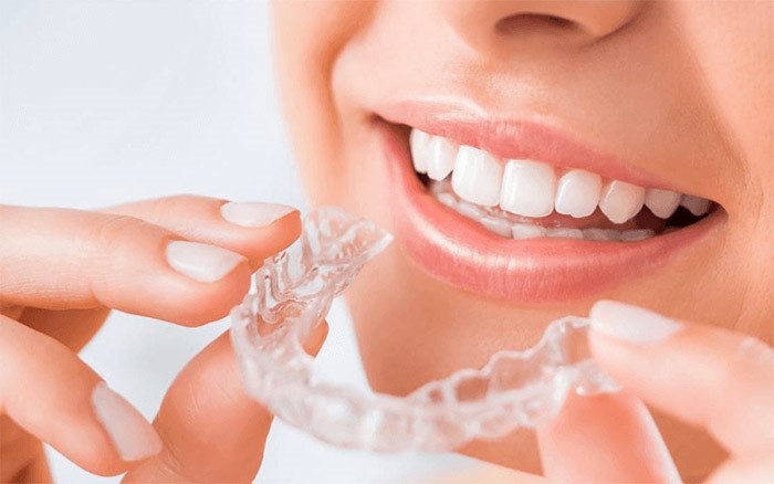 niềng răng trong suốt invisalign tại peace dentistry