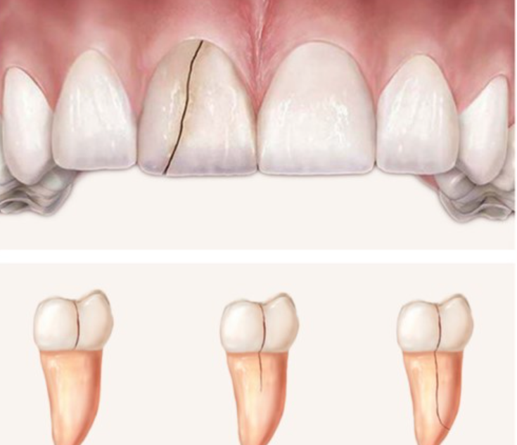 răng bị nứt có trám được không