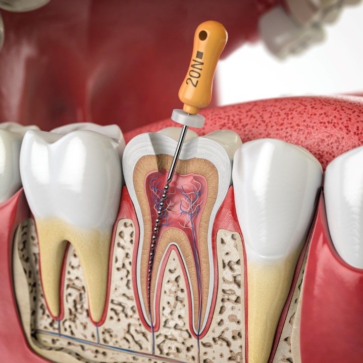 trám răng lấy tủy có đau không