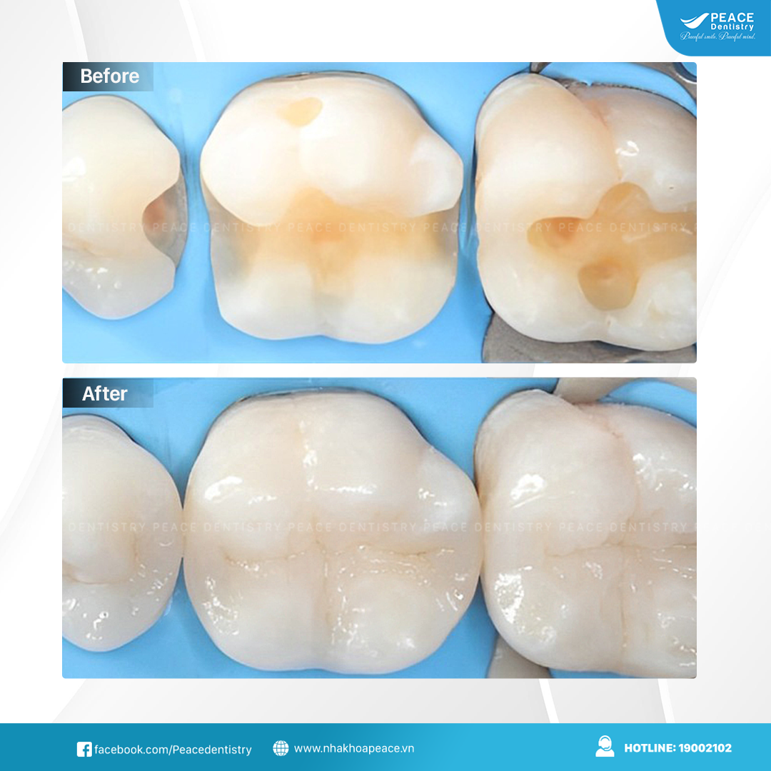 trám răng peace dentistry quận 3