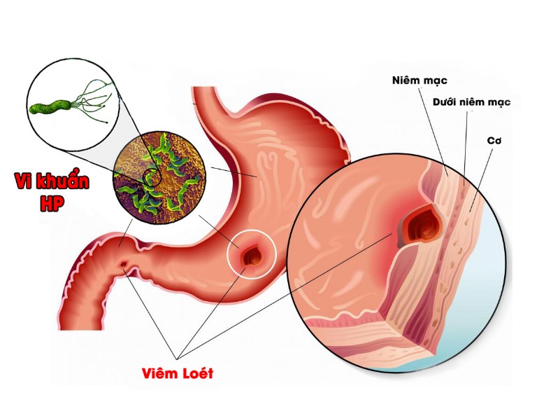 bệnh dạ dày gây hôi miệng