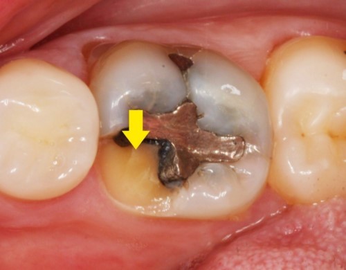 răng trám lâu ngày bị nhức