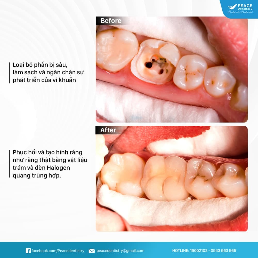 giá điều trị tủy răng sữa