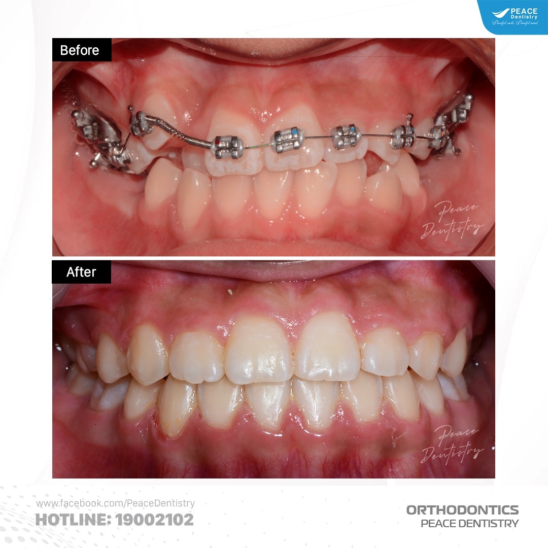 hình ảnh niềng răng tại peace dentistry