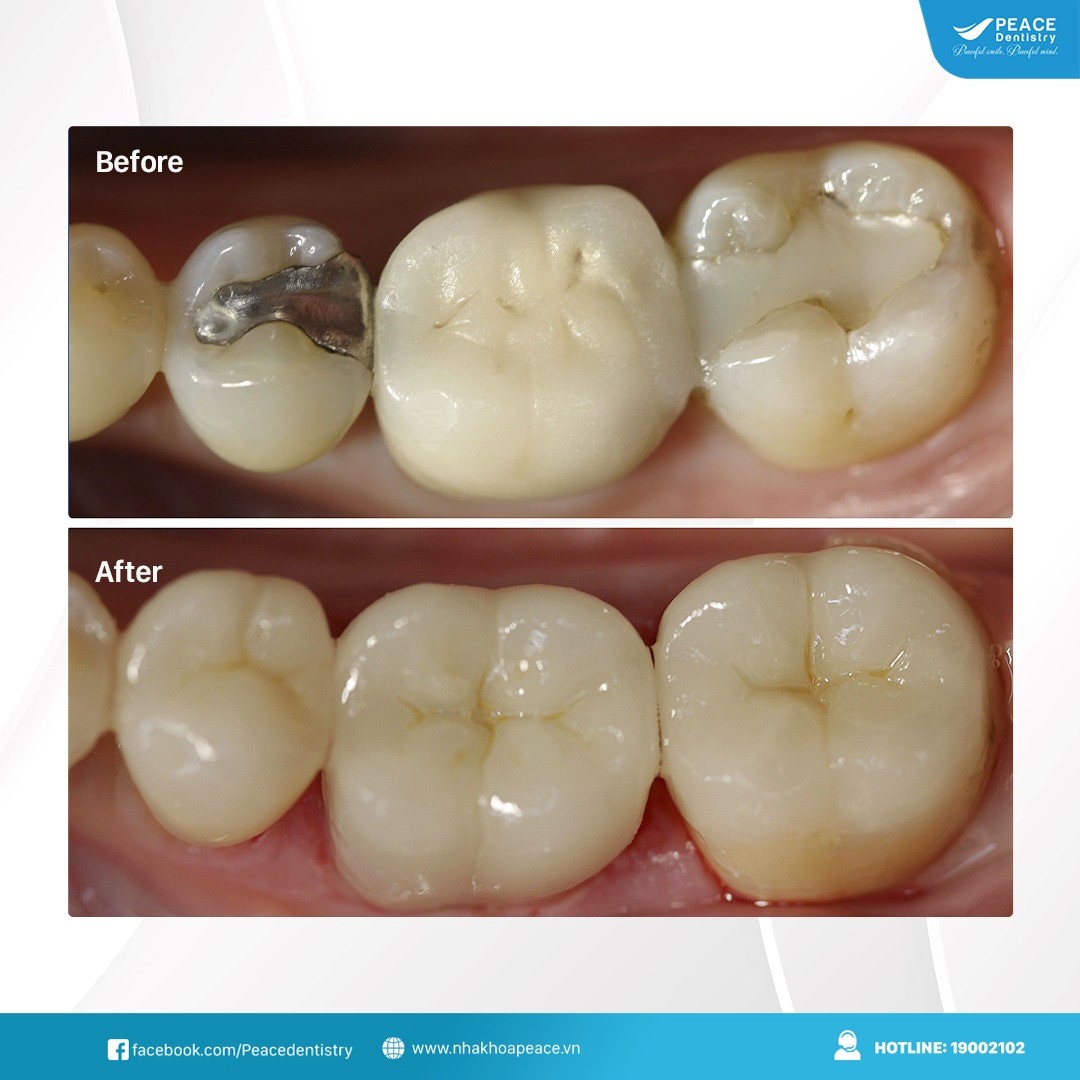 kết quả trám răng tại peace dentistry